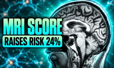 MRI score raises dementia risk 24 percent early-onset